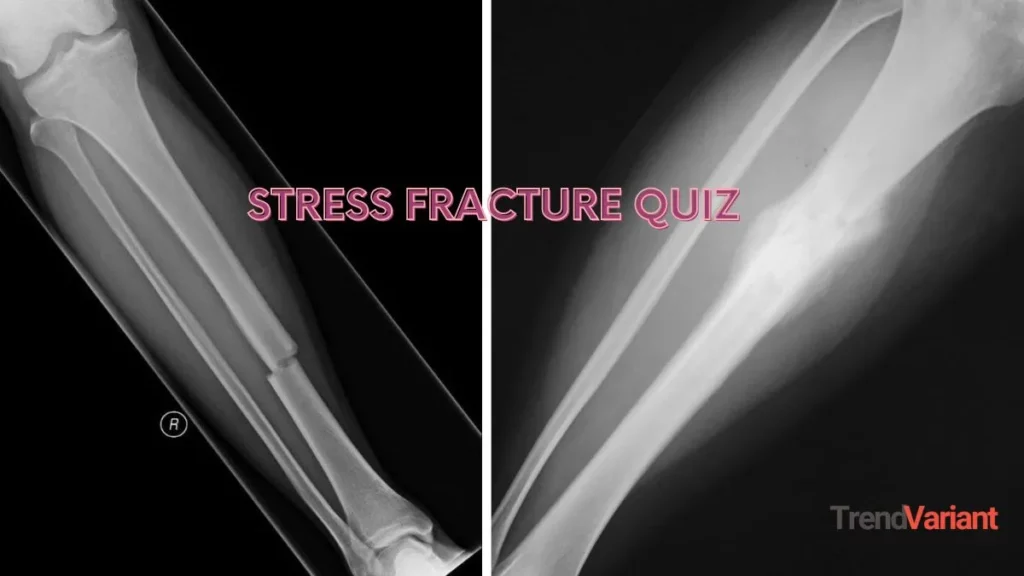 Stress Fracture Quiz
